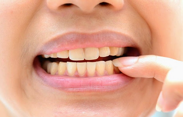 Nguy hại từ việc tẩy trắng răng giá rẻ không rõ nguồn gốc Nguy hại từ việc tẩy trắng răng giá rẻ không rõ nguồn gốc